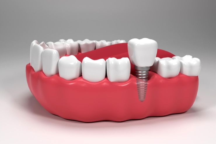 Dental Implants